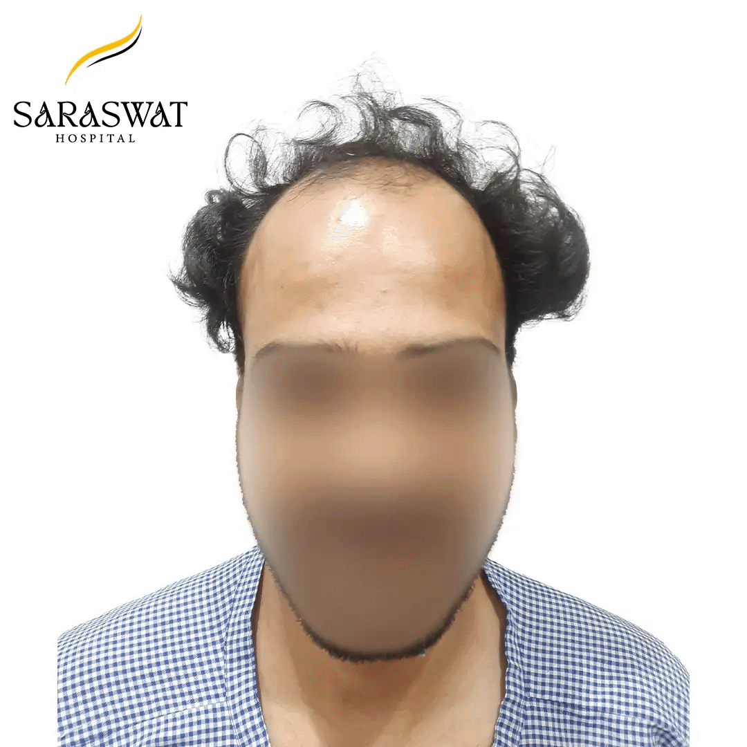 Hair Transplant Before and After Results