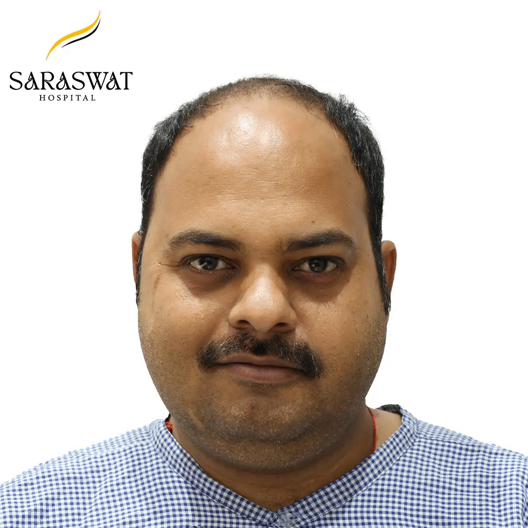 Hair Transplant Before and After