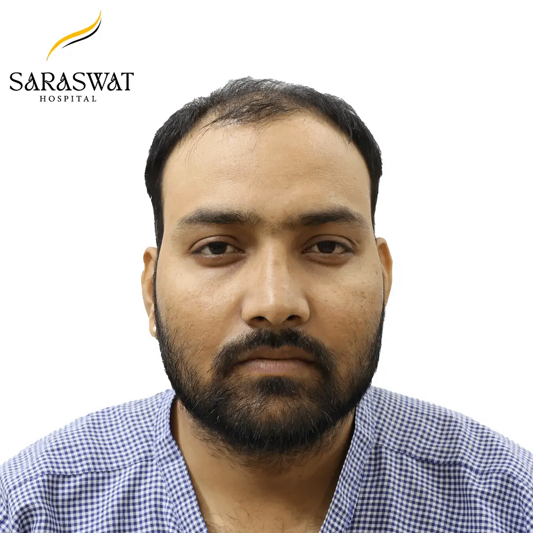 Hair Transplant Before After