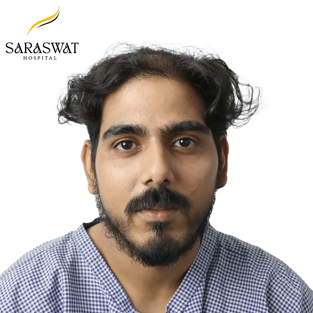 Hair Transplant Before After