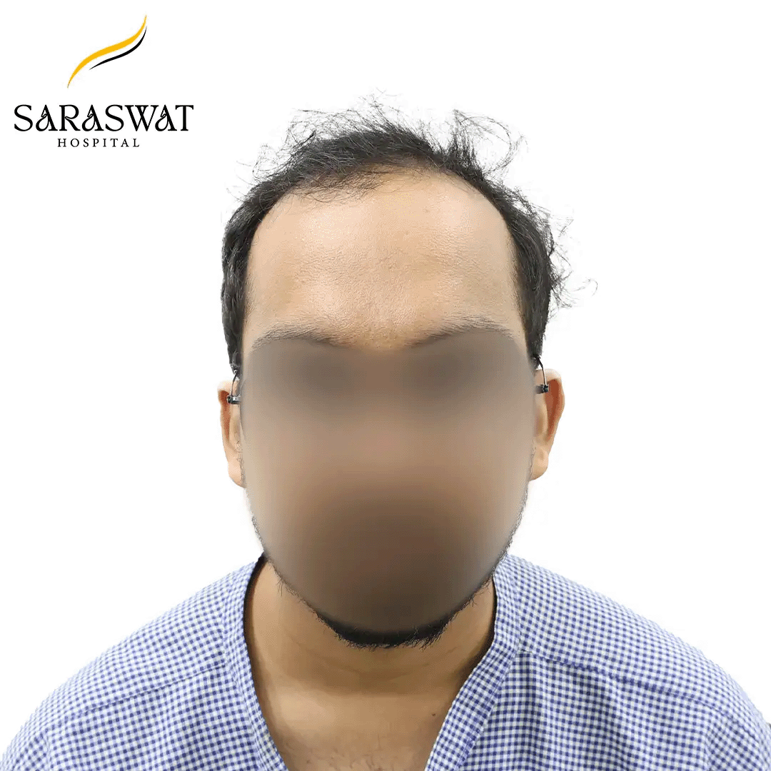 Hair Transplant Before After