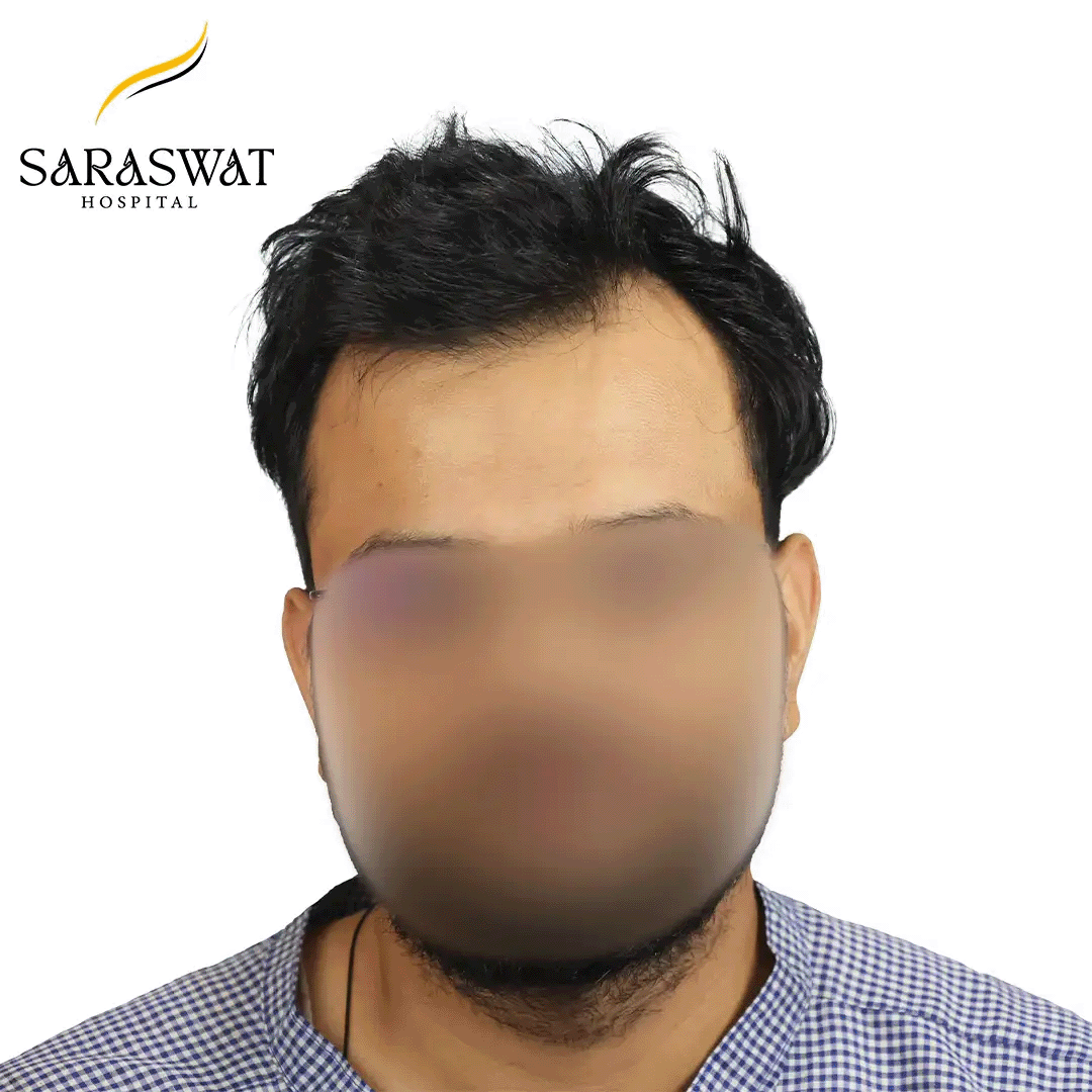 Hair Transplant Before After