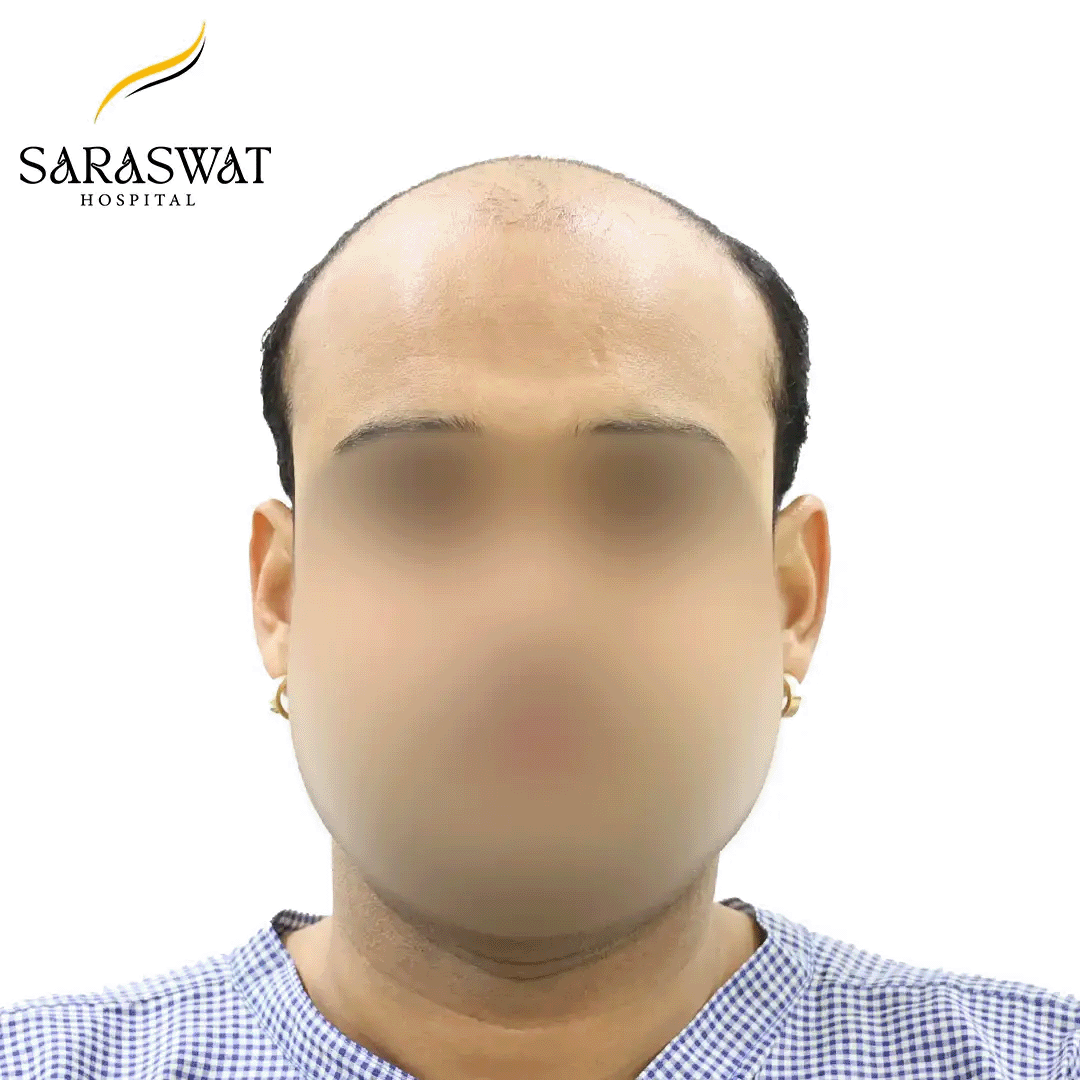 Hair Transplant Before and After Results