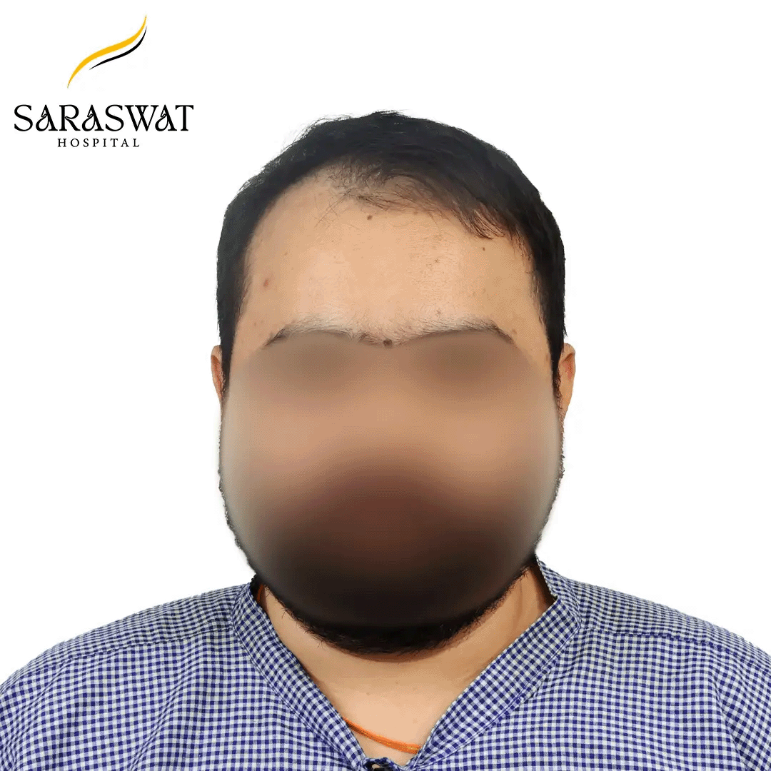 Hair Transplant Before and After Results