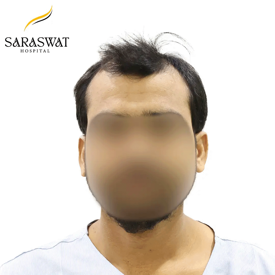 Hair Transplant Before After