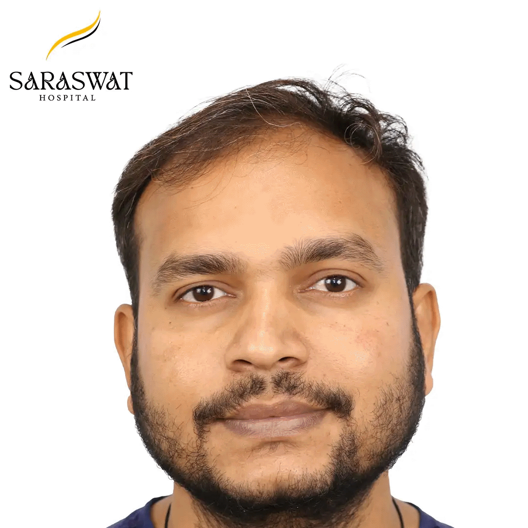 Hair Transplant Before and After Results