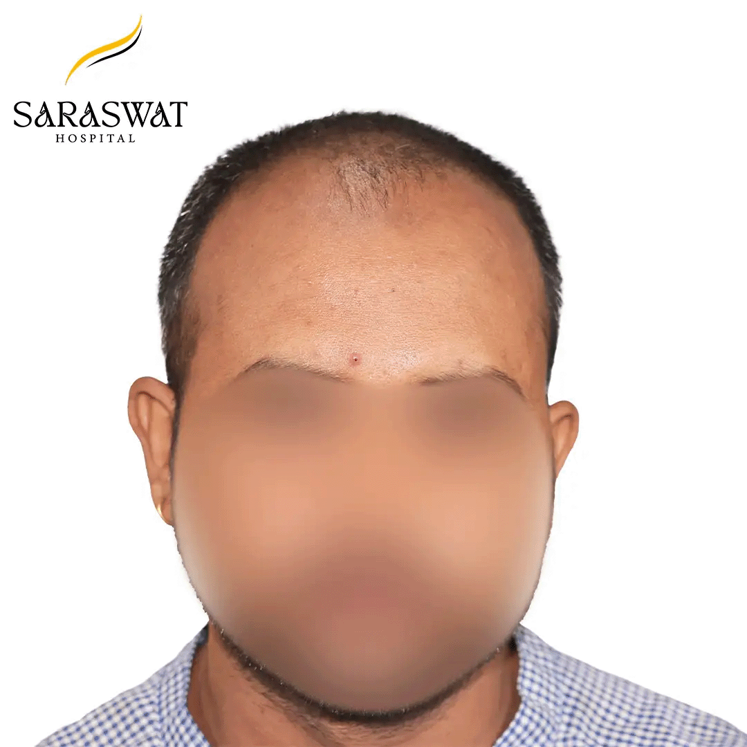 Hair Transplant Before After