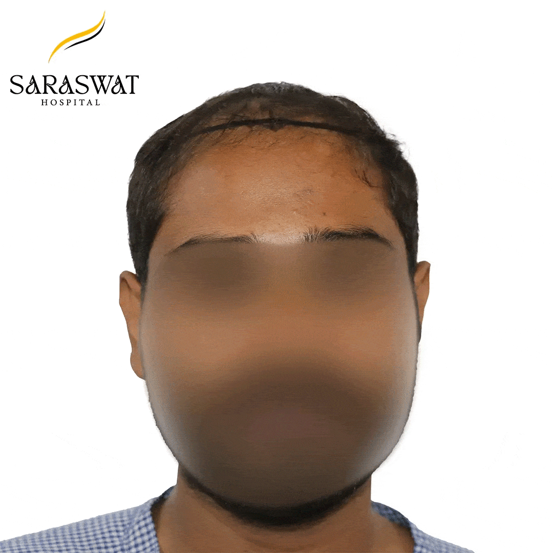 Hair Transplant Before and After Results