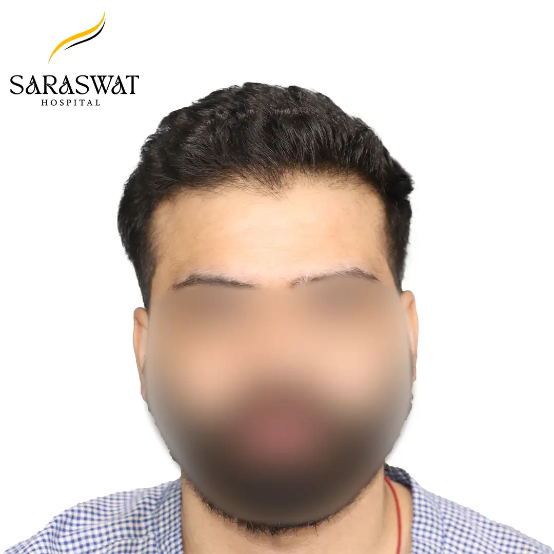 Hair Transplant Before and After