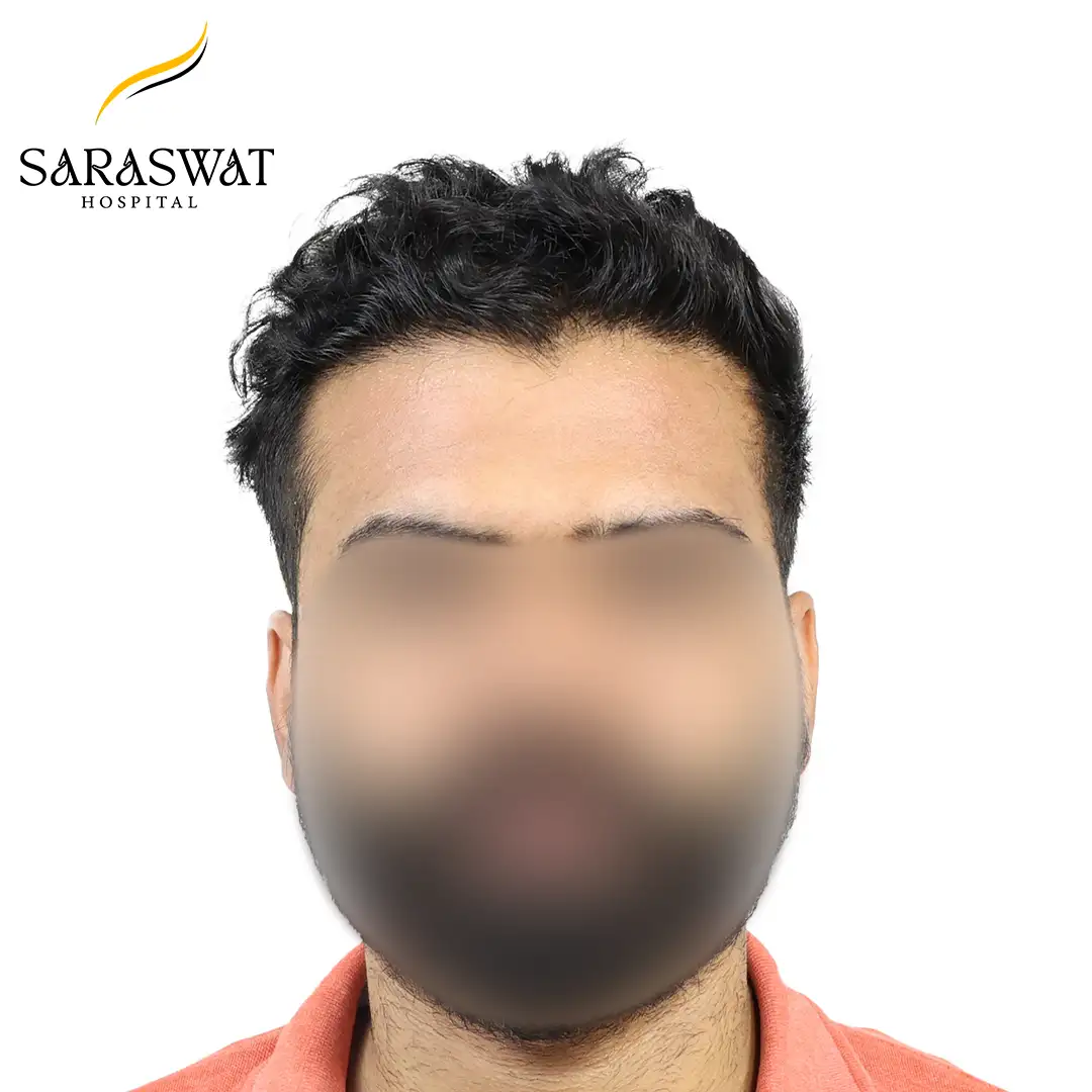 Hair Transplant Before and After