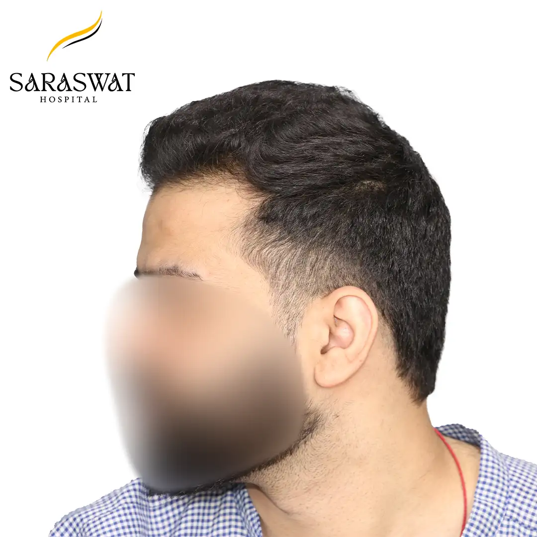 Hair Transplant Before and After Results
