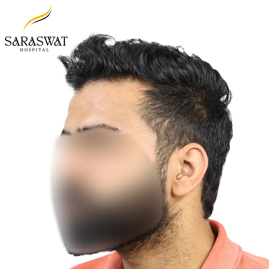 Hair Transplant Before and After Results