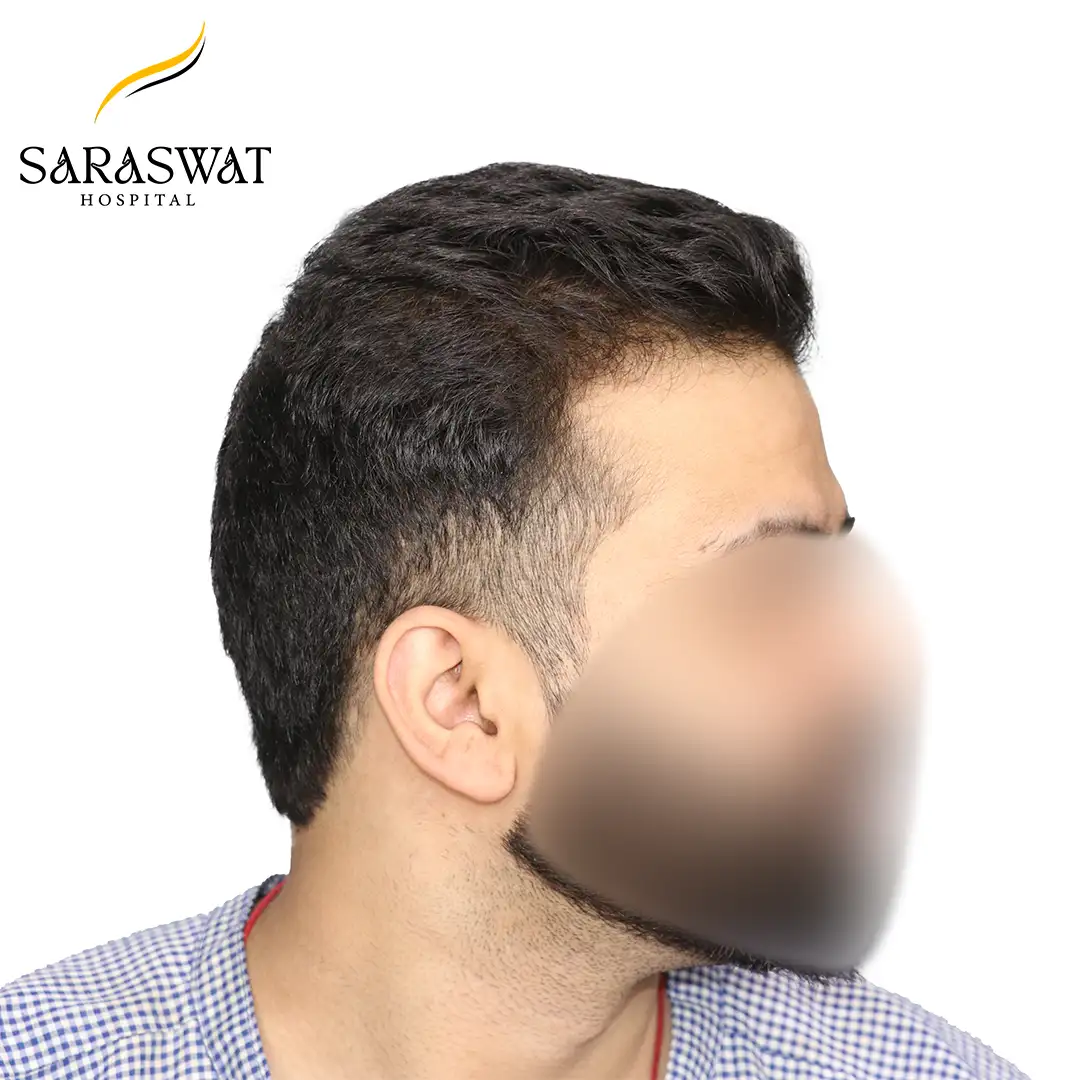 Hair Transplant Before and After Results