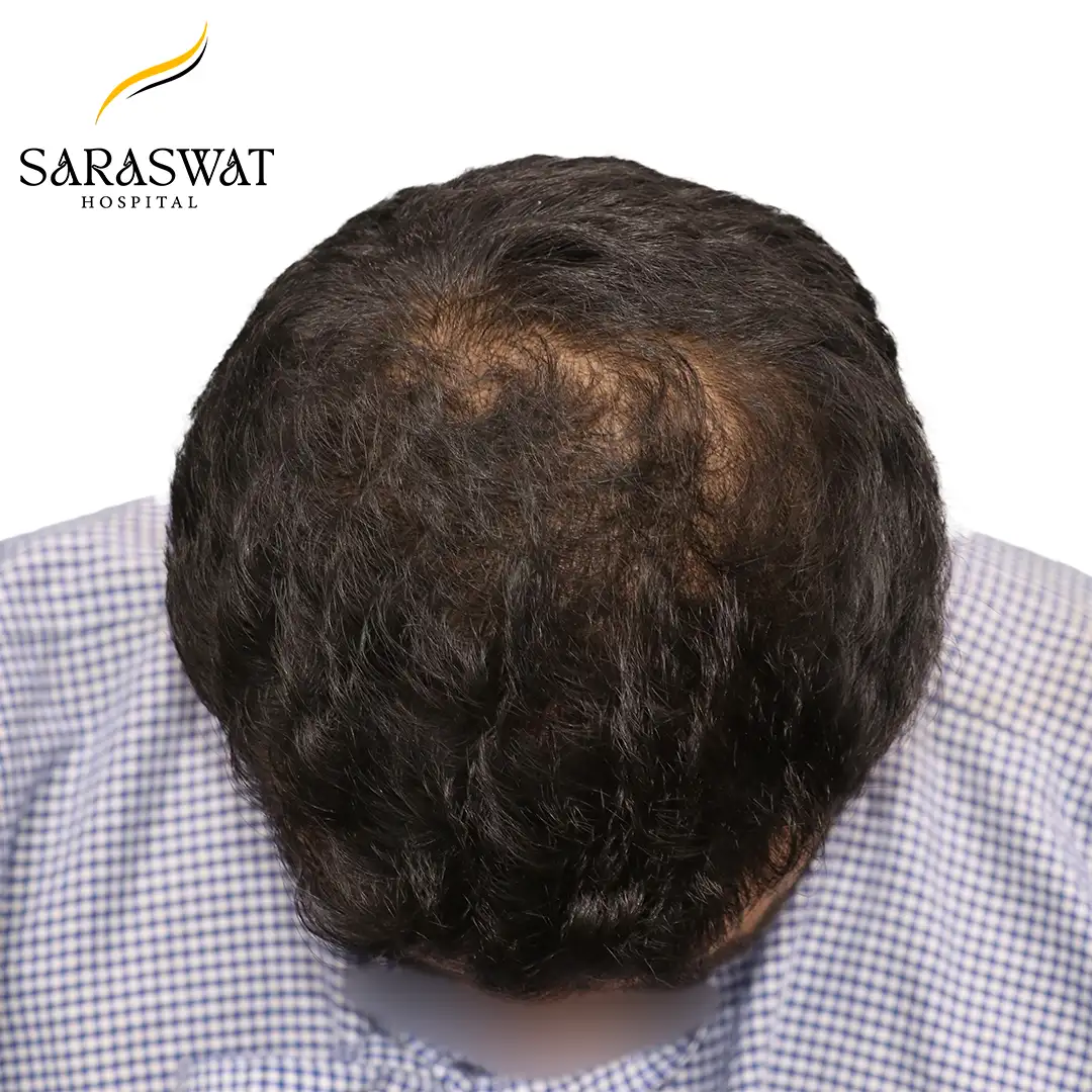Hair Transplant Before and After