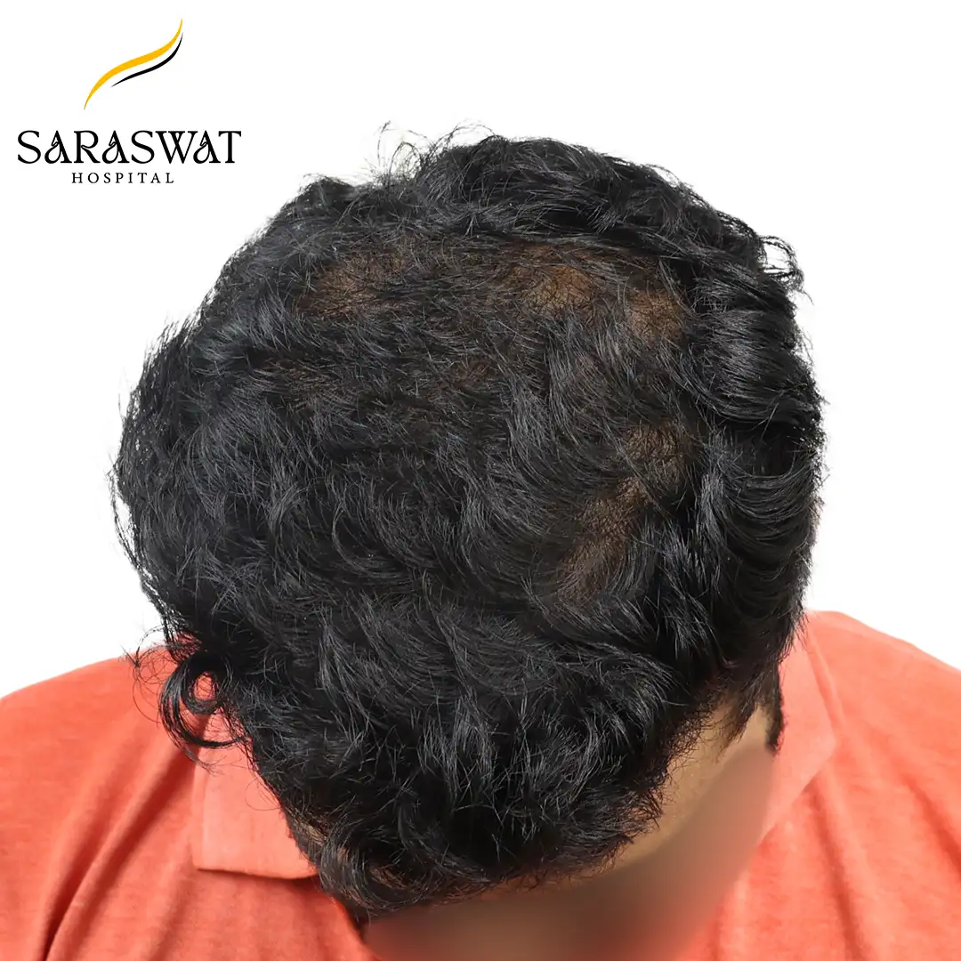 Hair Transplant Before and After