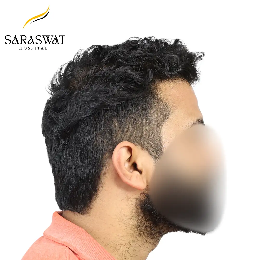 Hair Transplant Before and After Results