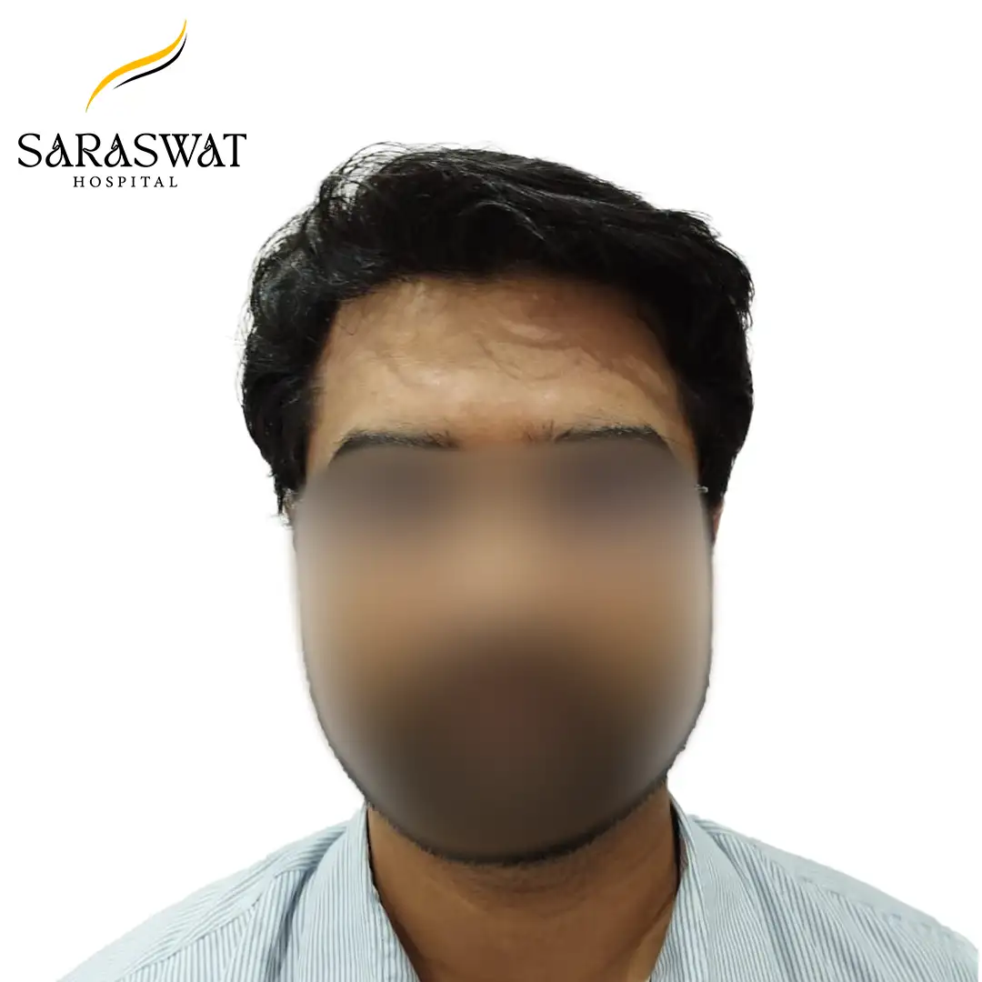 Hair Transplant Before and After Results