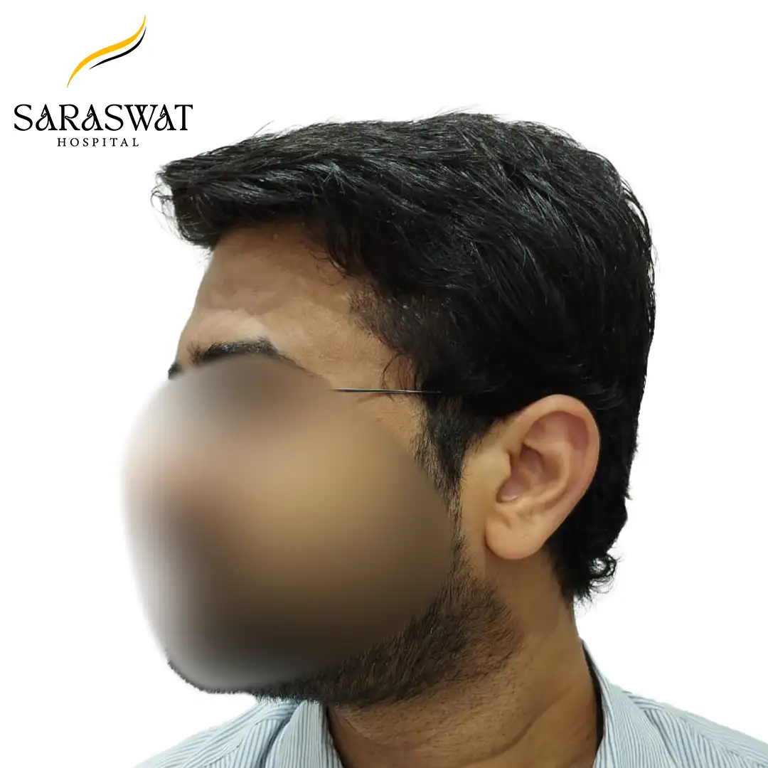 Hair Transplant Result