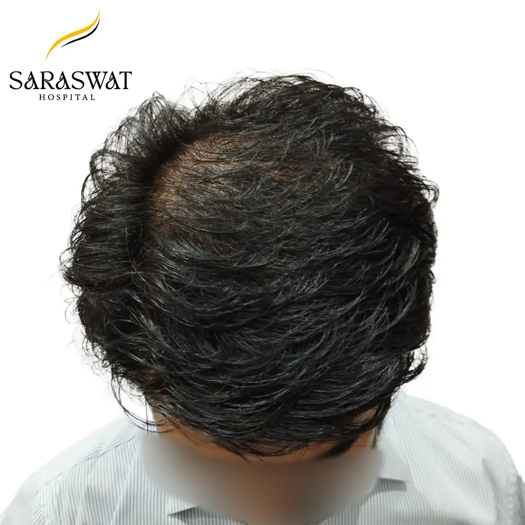 Hair Transplant Before and After Results
