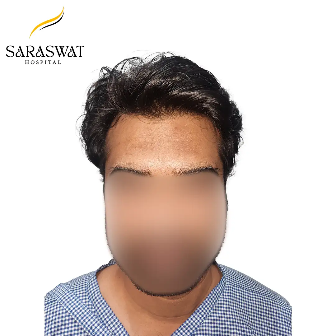 Hair Transplant Before and After Results