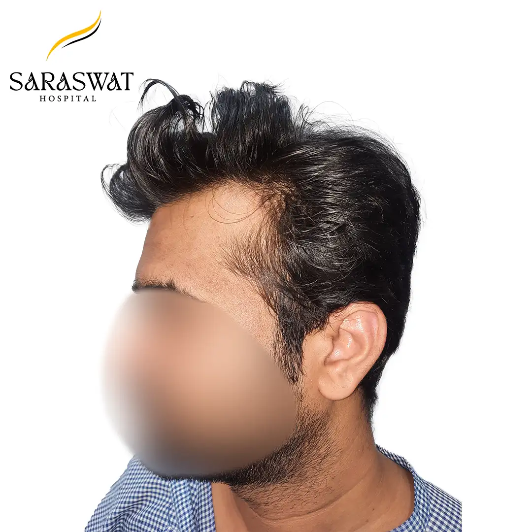 Hair Transplant Result