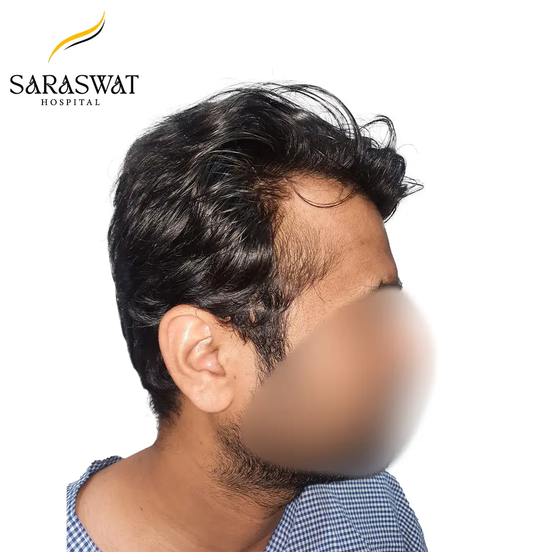 Hair Transplant Result