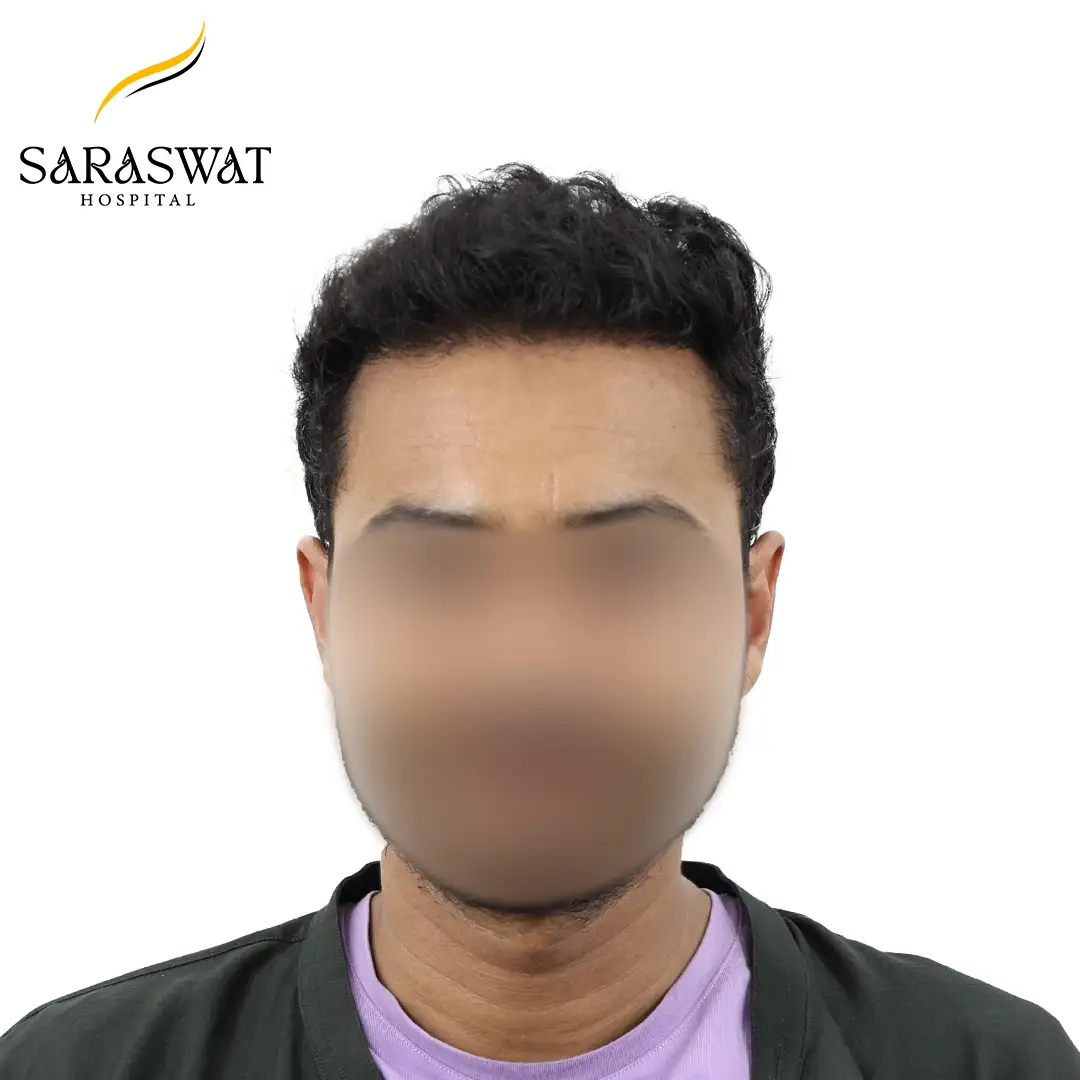 Front FUE Hair Transplant Before After