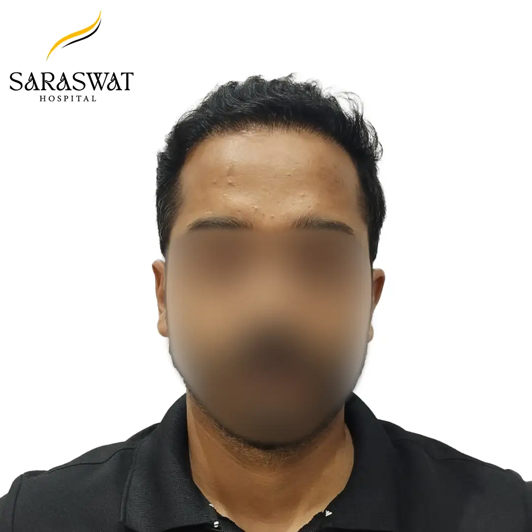 Hair Transplant Before and After Results