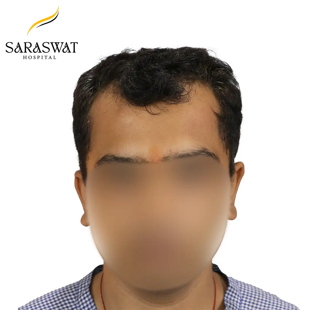 Front FUE Hair Transplant Result Before Procedure