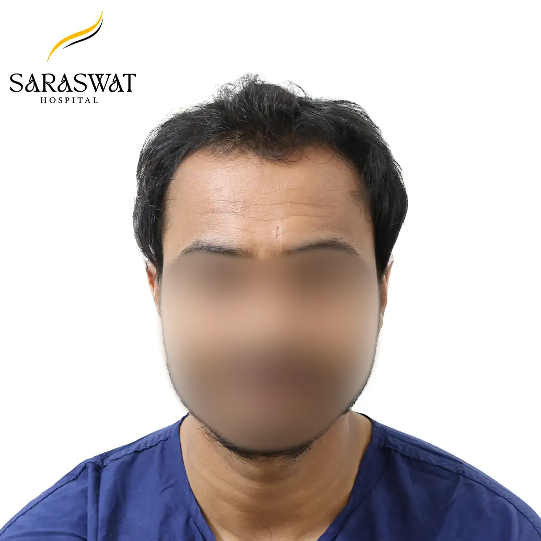 Front FUE Hair Transplant Before After