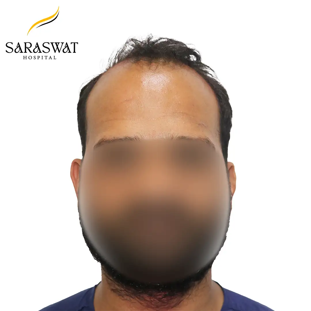 Front FUE Hair Transplant Result Before Procedure