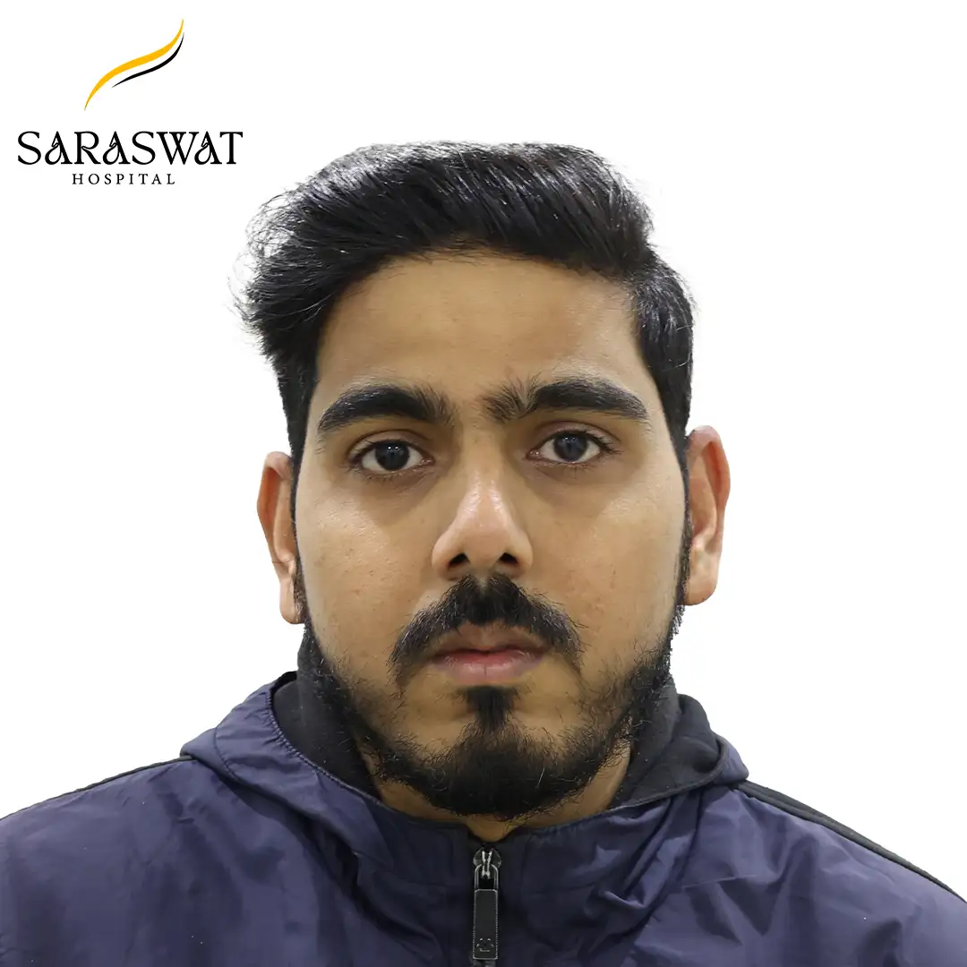 Front FUE Hair Transplant Result After Procedure