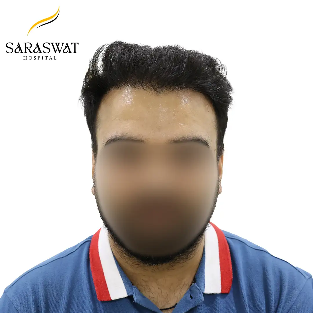 Hair Transplant Before and After