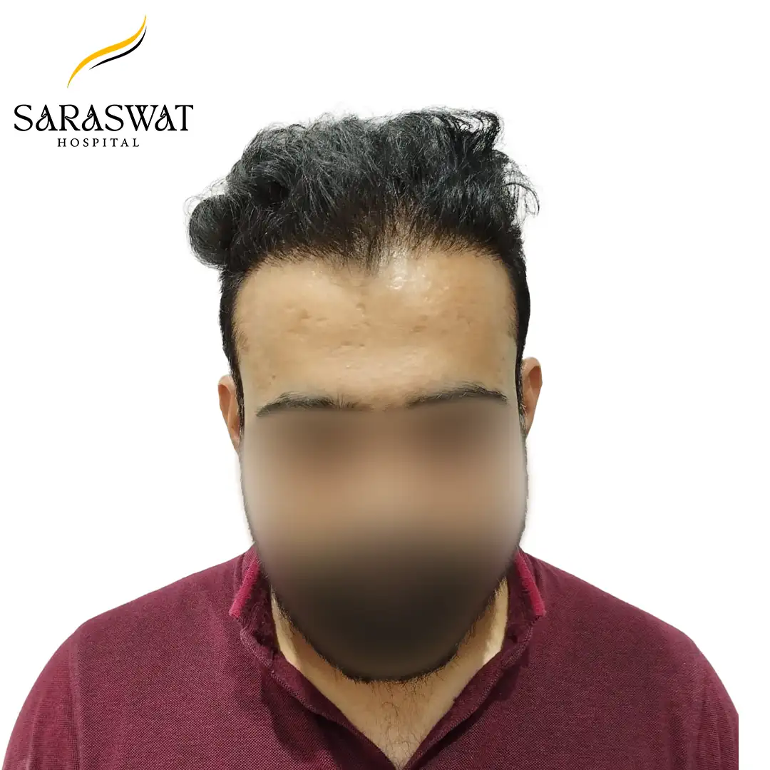 Hair Transplant Before and After Result