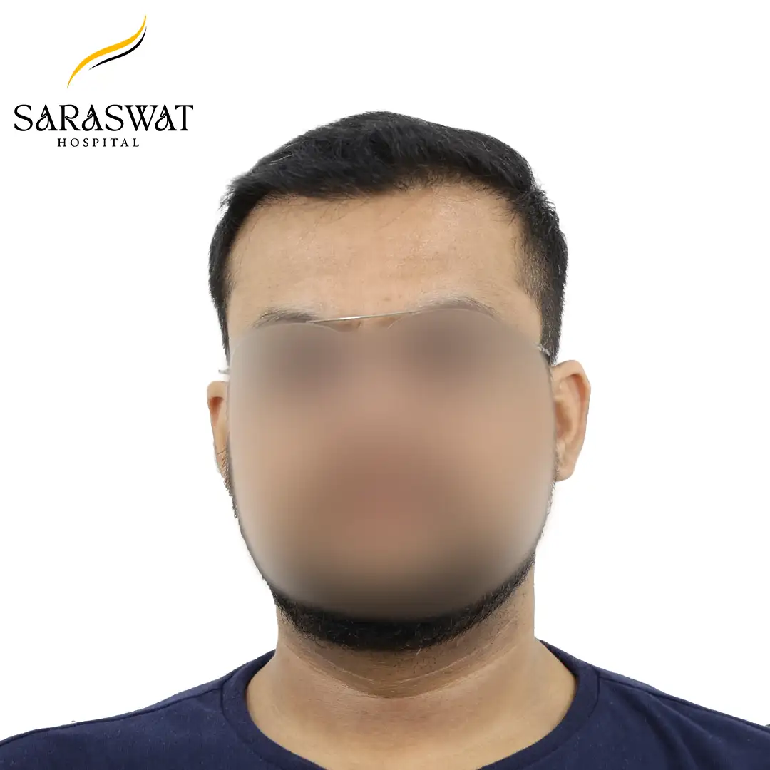 Front FUE Hair Transplant Result After Procedure