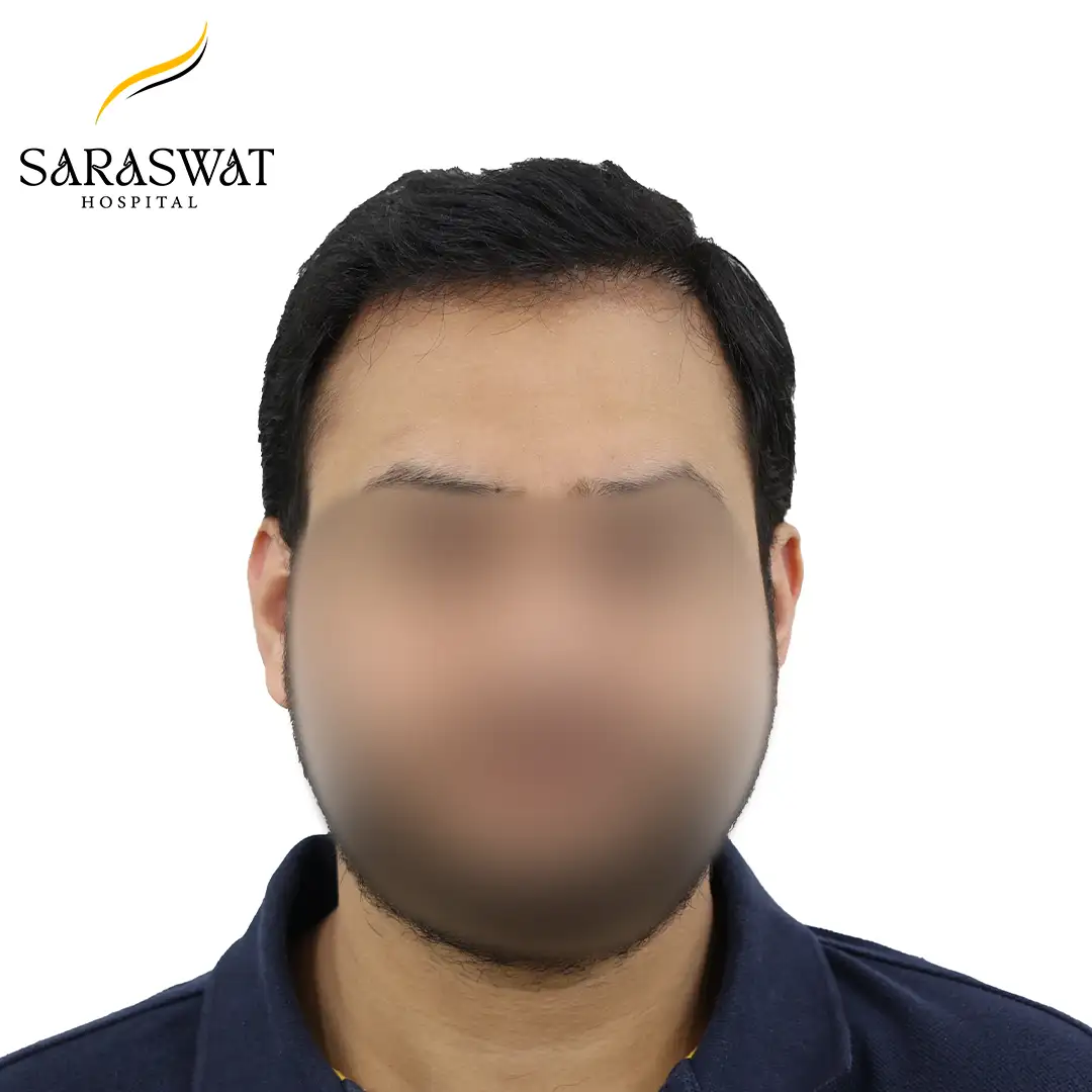 Hair Transplant Before and After Results