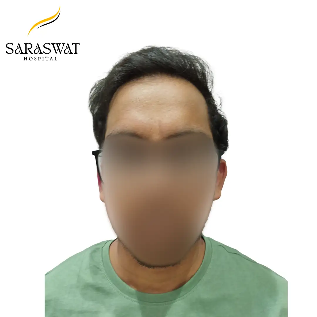Front FUE Hair Transplant Result After Procedure