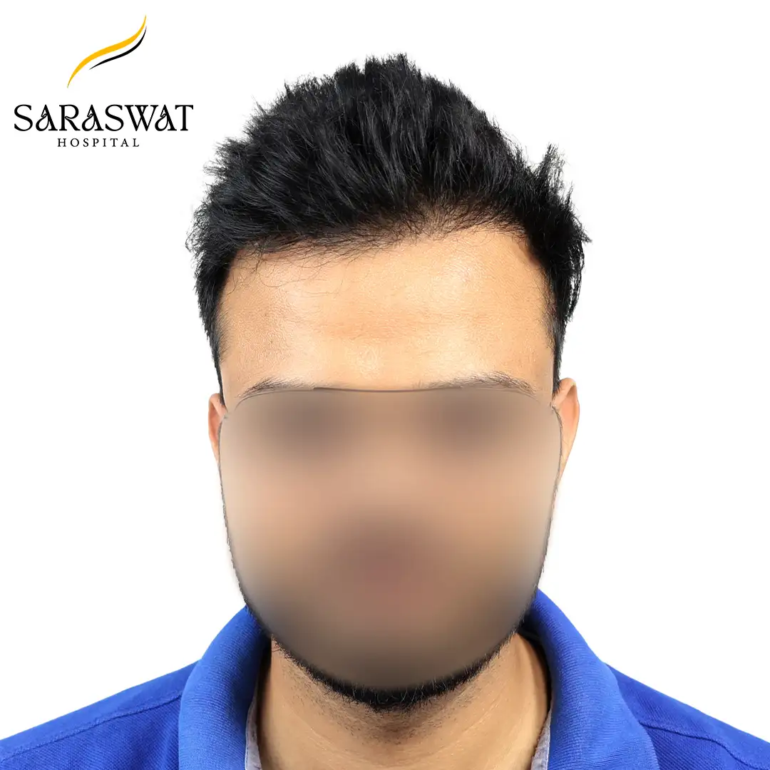 FUE Hair Transplant