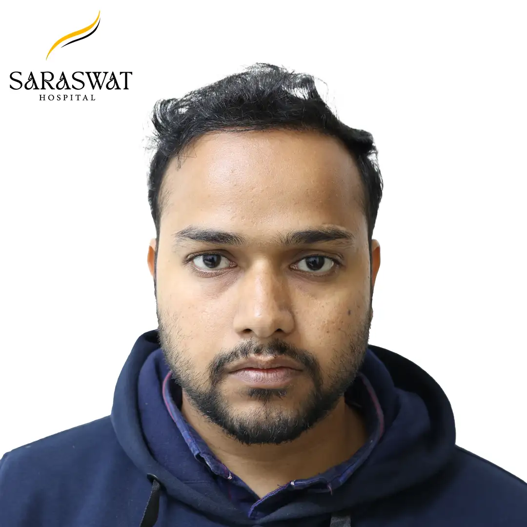 Front FUE Hair Transplant Result After Procedure