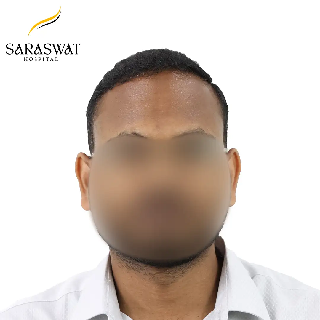 Hair Transplant Before and After Results