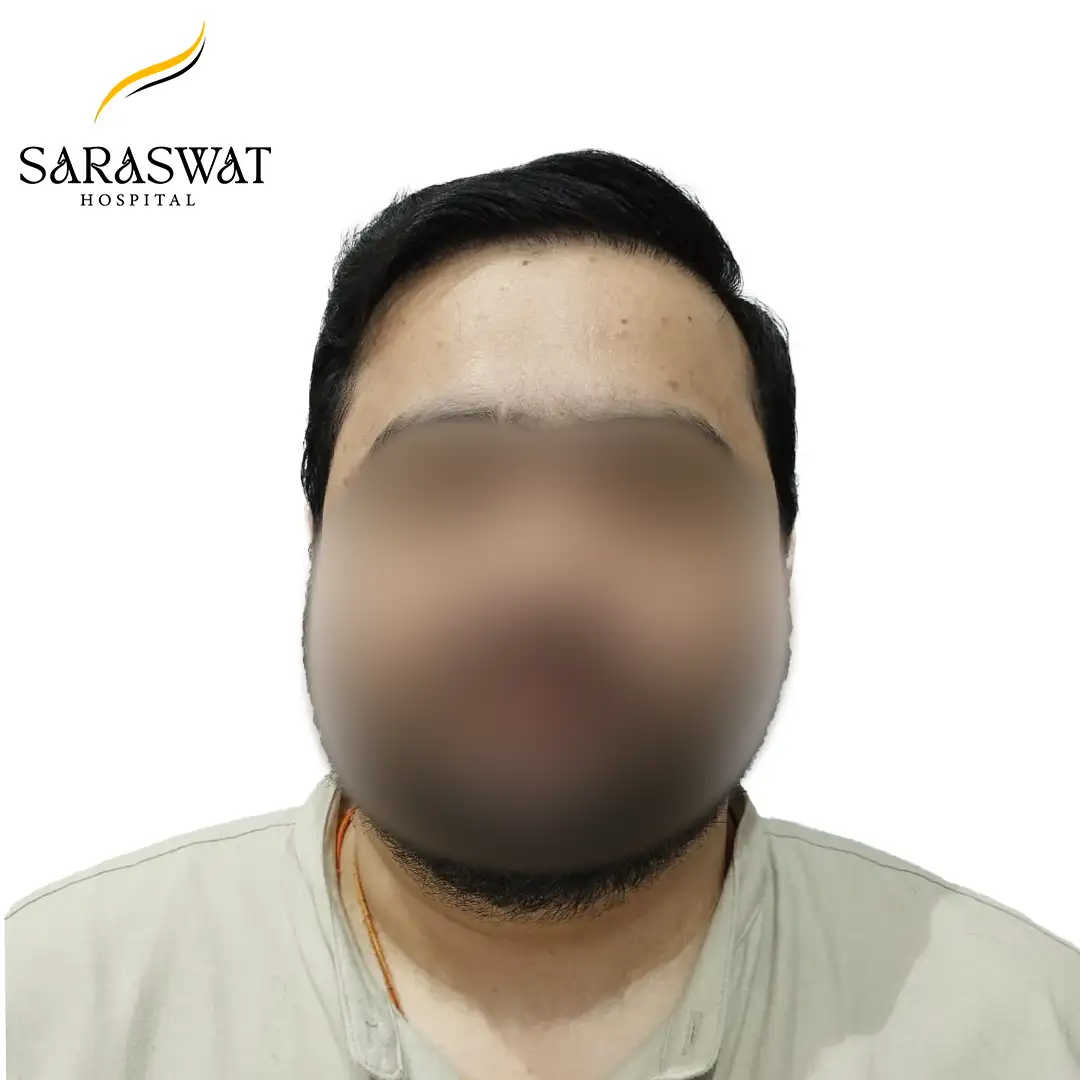 Front FUE Hair Transplant Result After Procedure