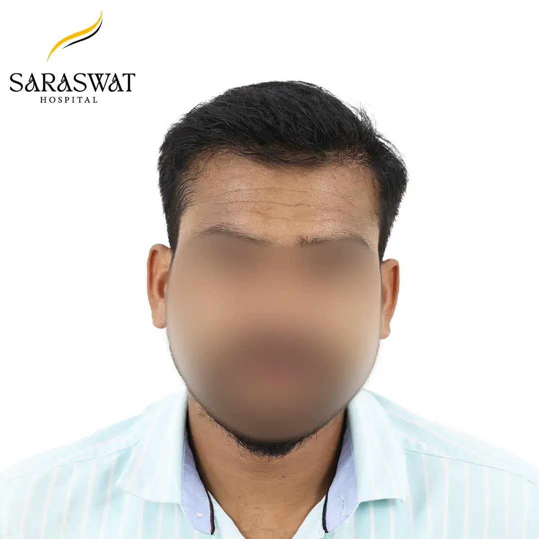 Front FUE Hair Transplant Result After Procedure