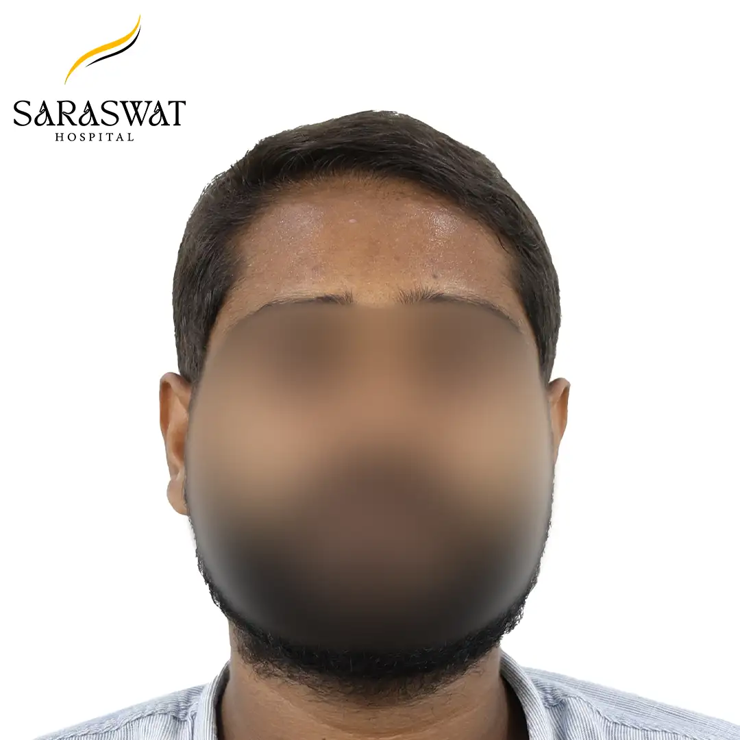 Front FUE Hair Transplant Result After Procedure