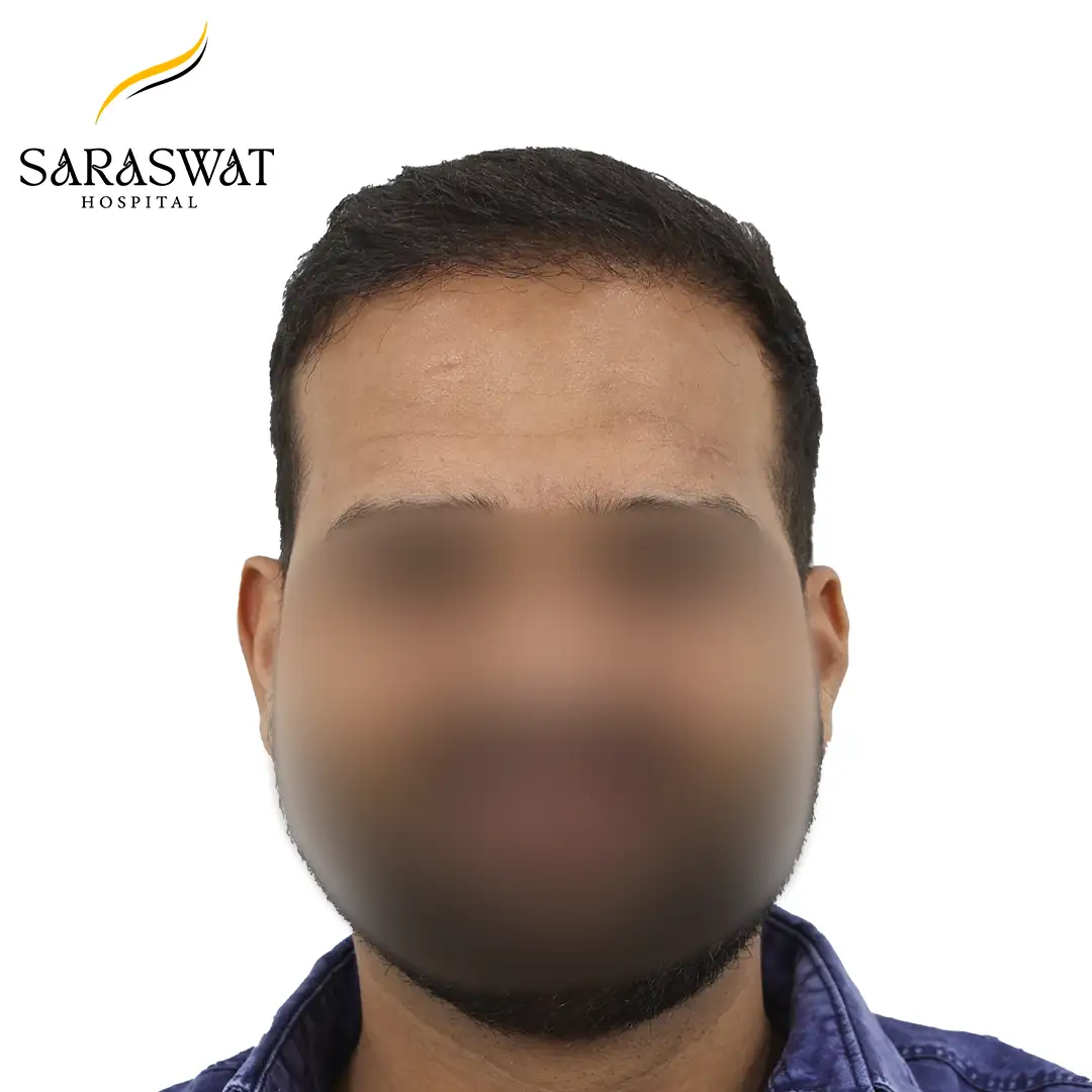 Front FUE Hair Transplant Result After Procedure