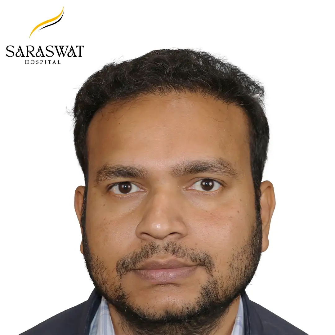 Front FUE Hair Transplant Result After Procedure