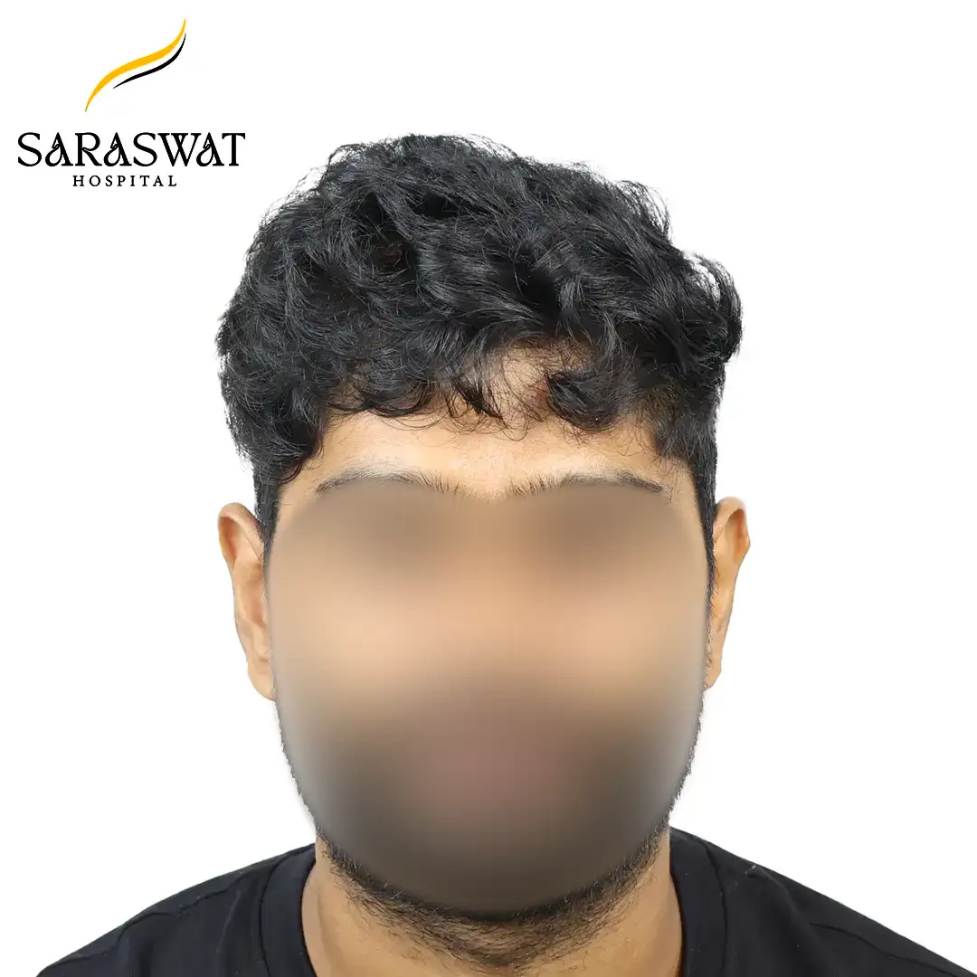 Front FUE Hair Transplant Result After Procedure