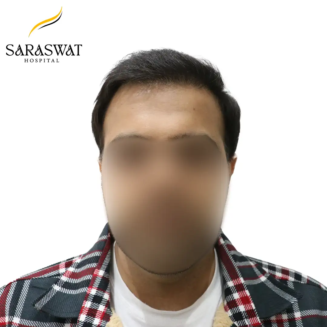 Hair Transplant Before and After