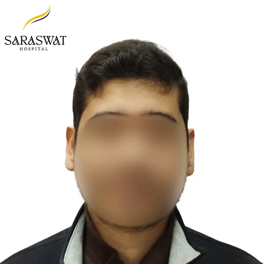 Front FUE Hair Transplant Result After Procedure