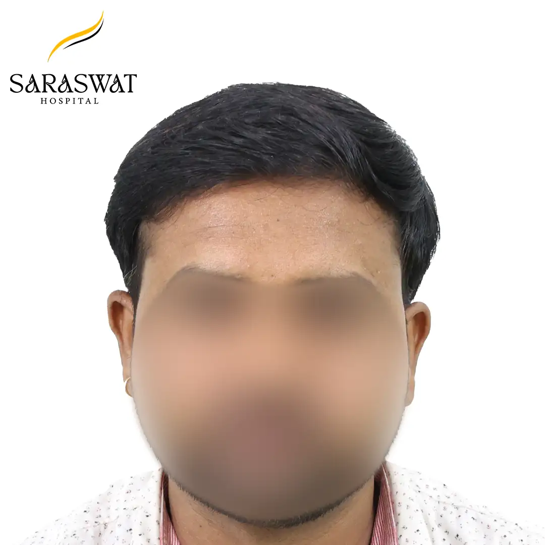 Hair Transplant Before and After