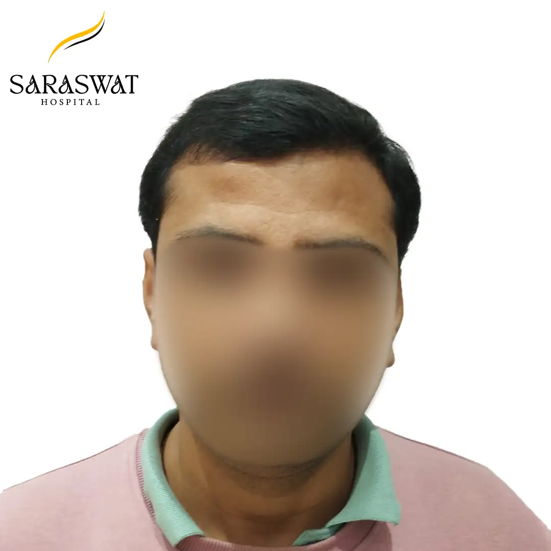 Front FUE Hair Transplant Result After Procedure